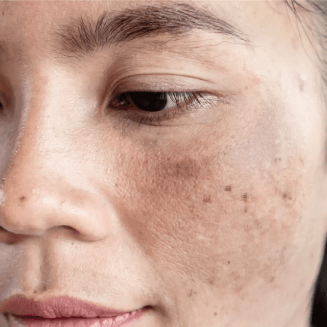 Pigment & Melasma 12 Month Program at Tasha Bruno Beauty & Esthetics in Windermere, FL