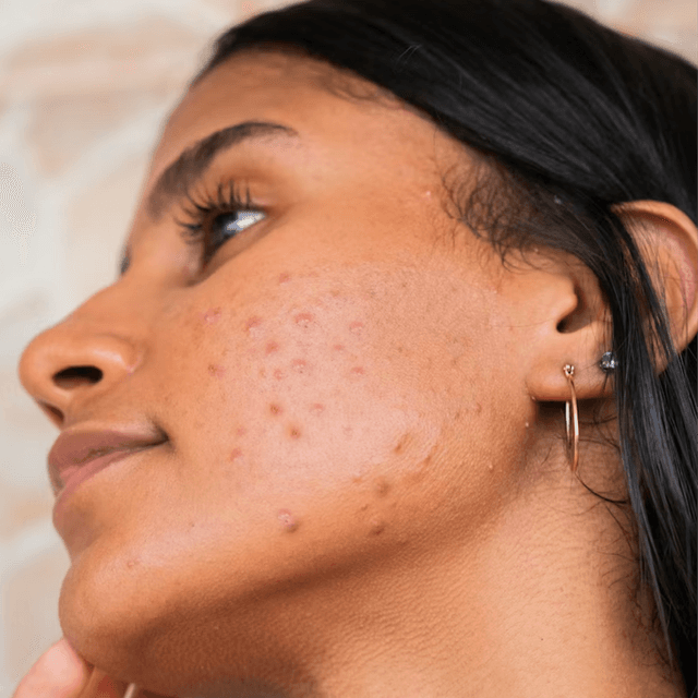 Acne & Barrier 12 Month Program at Tasha Bruno Beauty & Esthetics in Windermere, FL