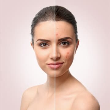Acne & Barrier 6 - 8 Month Program at Tasha Bruno Beauty & Esthetics in Windermere, FL