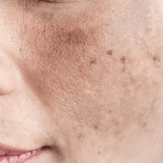 Pigment & Melasma 6-8 Month Program at Tasha Bruno Beauty & Esthetics in Windermere, FL